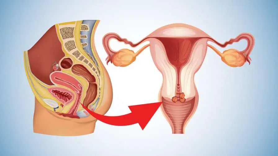cervical-cancer